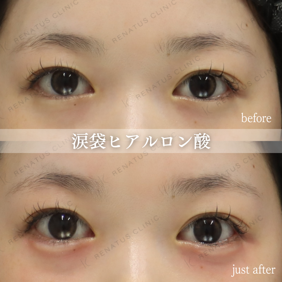 涙袋ヒアルロン酸 注入前後の症例写真